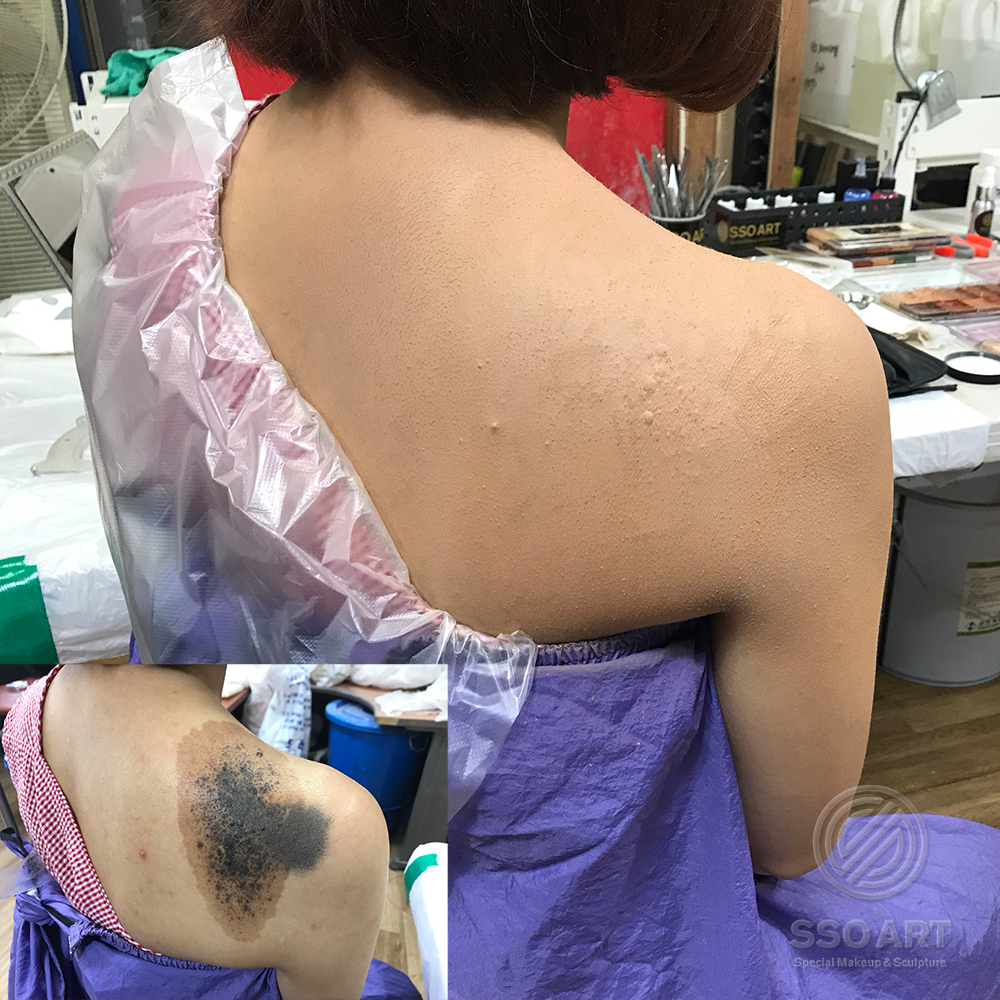 점 흉터 커버